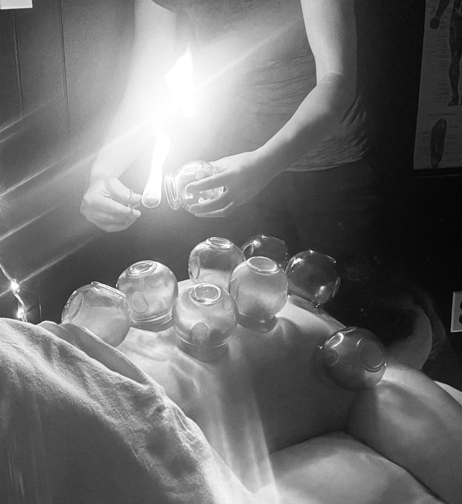 Chinese fire cupping at Silver Birch
